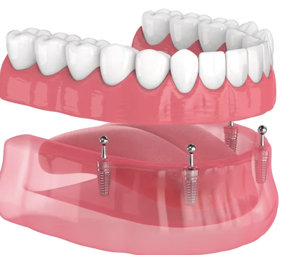 Implant denture being fitted for patient in Grayson dental office